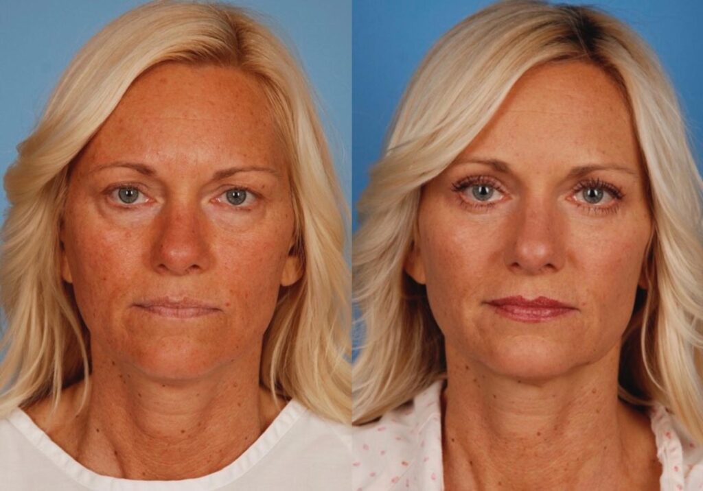 eyelid surgery