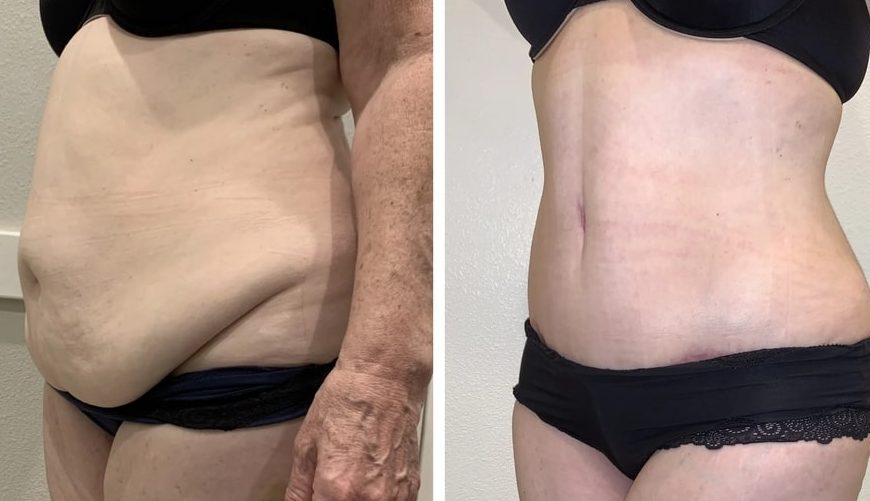 Liposuction vs. Tummy Tuck