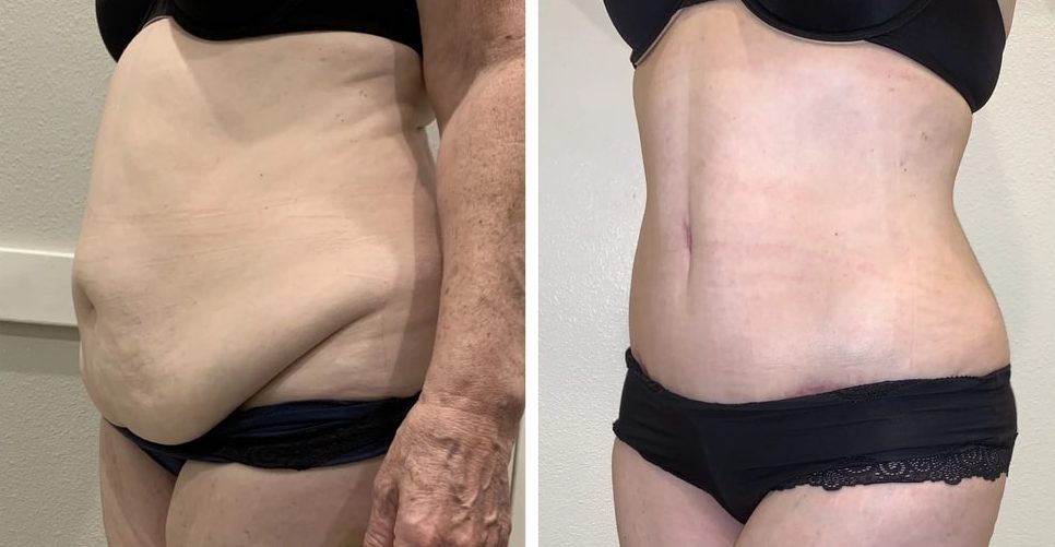 Liposuction vs. Tummy Tuck